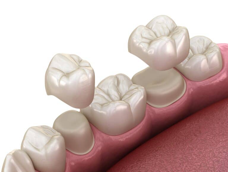 porcelain crowns, Dental Crowns