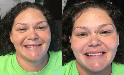 Smile makeover #1