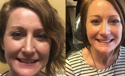 Smile makeover #2