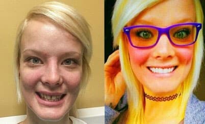 Smile makeover #3