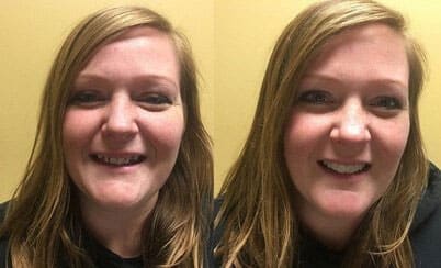 Smile makeover #4