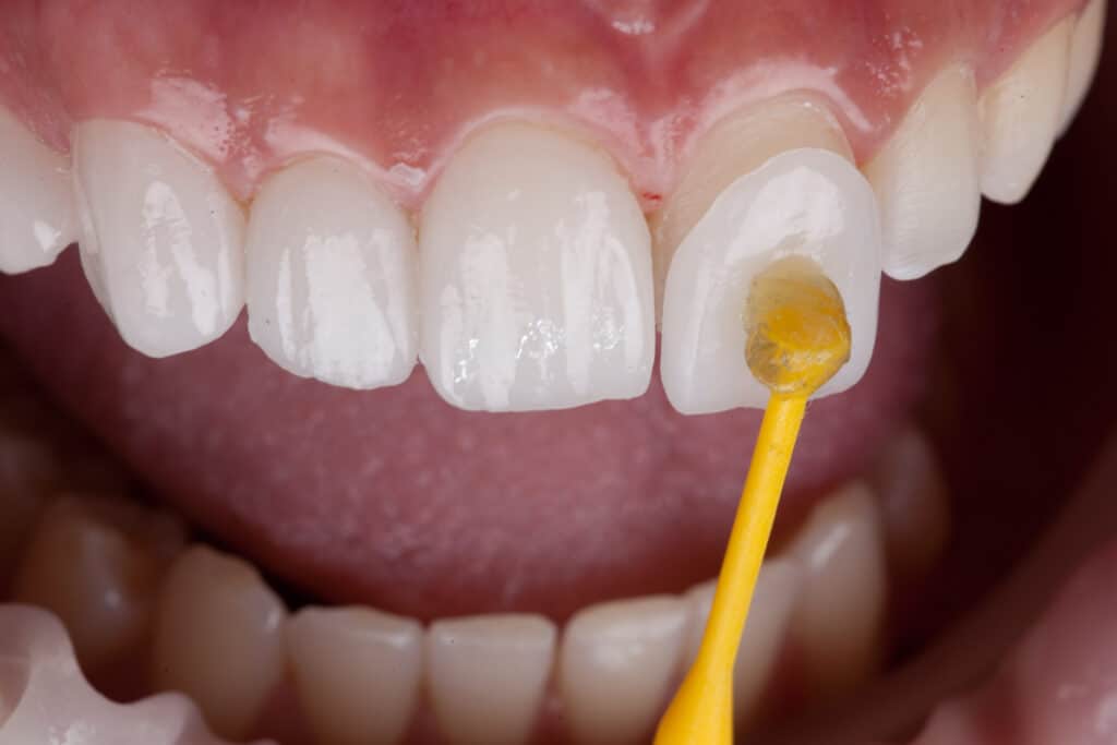 veener being added to tooth, Porcelain Veneers