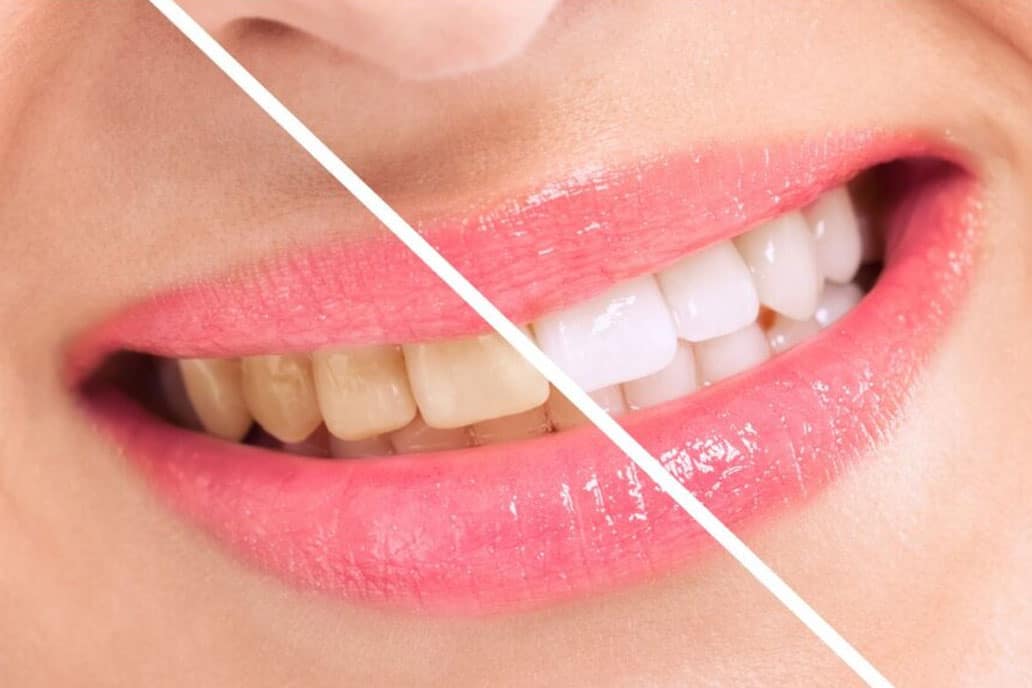whitening 4, Teeth Whitening