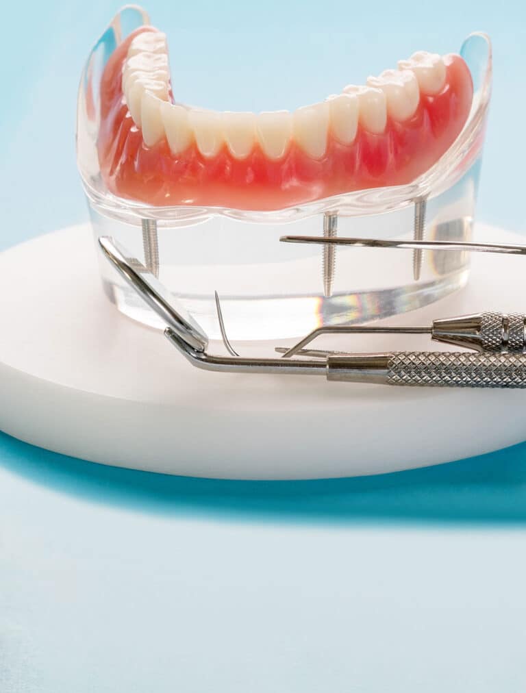crown bridge benefits, Implant Supported Bridge