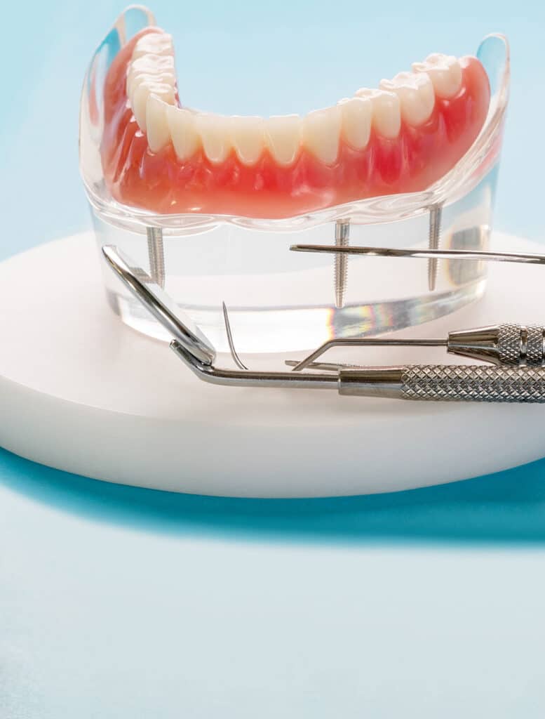 crown bridge benefits, Transforming Lives with Full-Arch Dental Implants