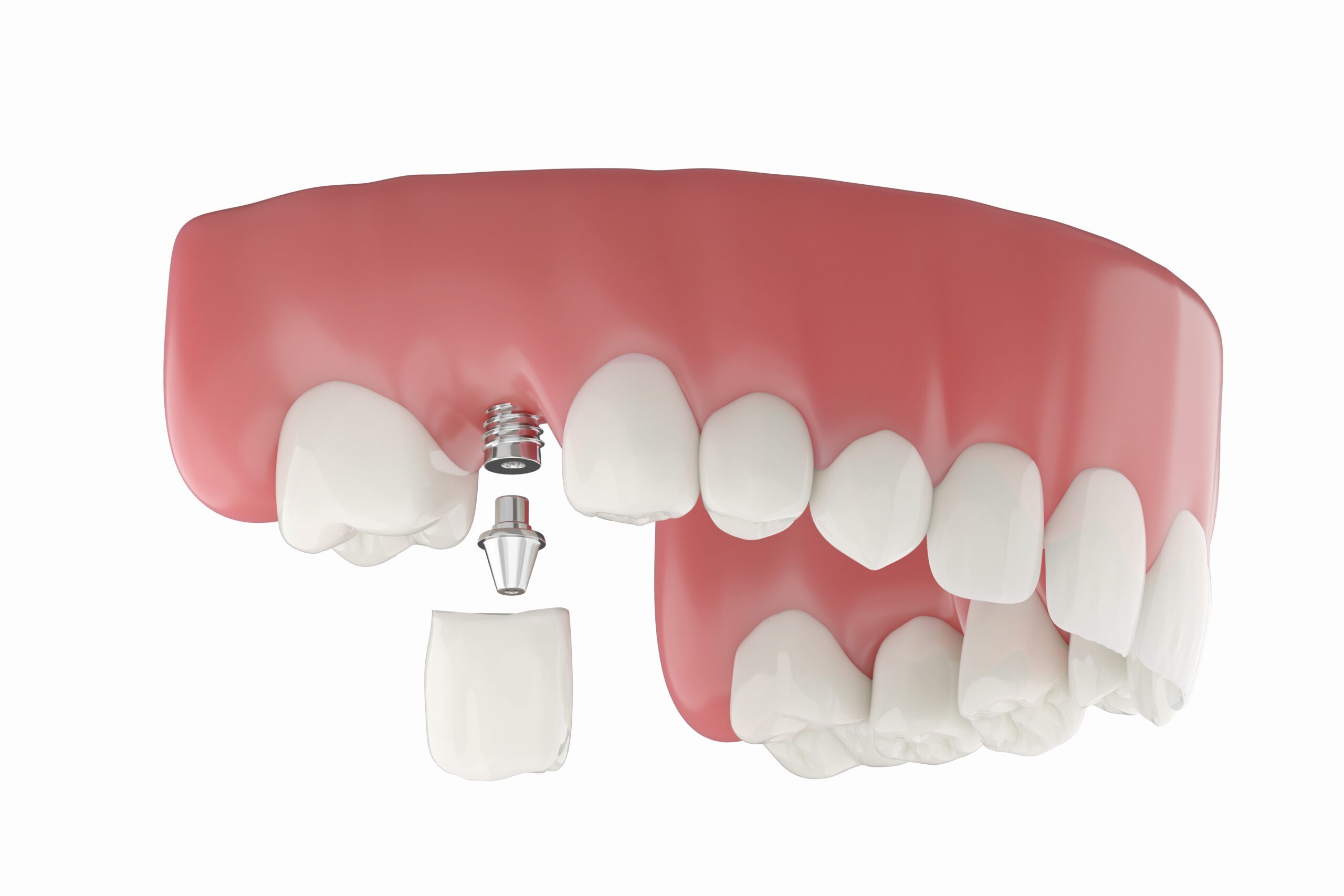 shutterstock 2439304103 scaled, Single Tooth Dental Implant