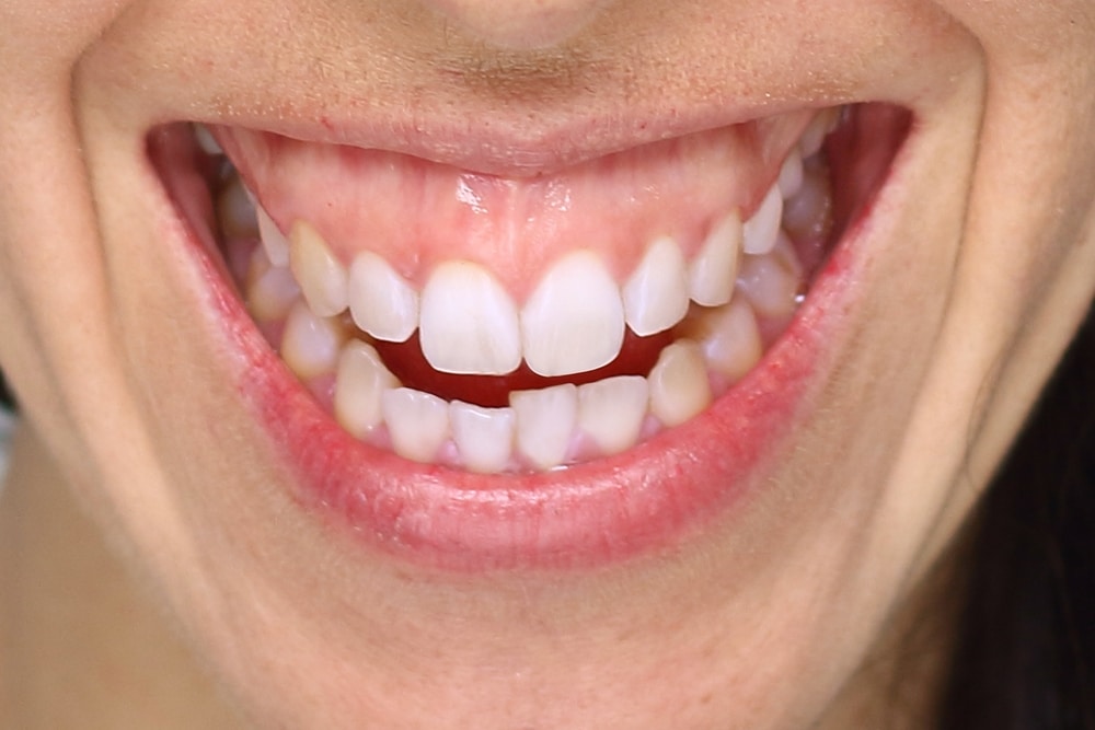 A close-up of a woman's gummy smile