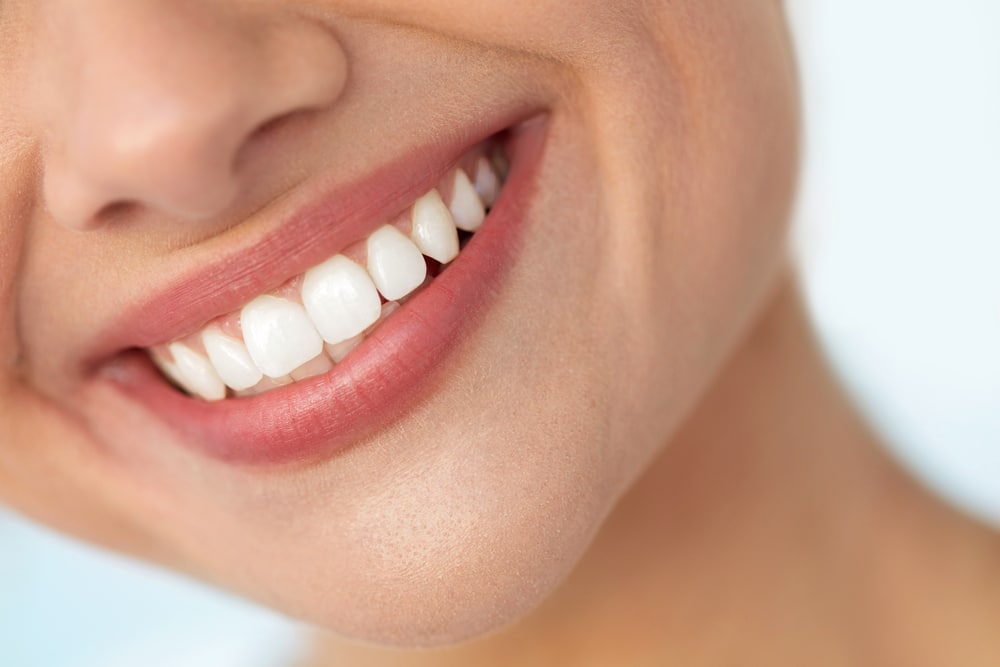 A close-up of a beautiful smile after gummy smile treatment