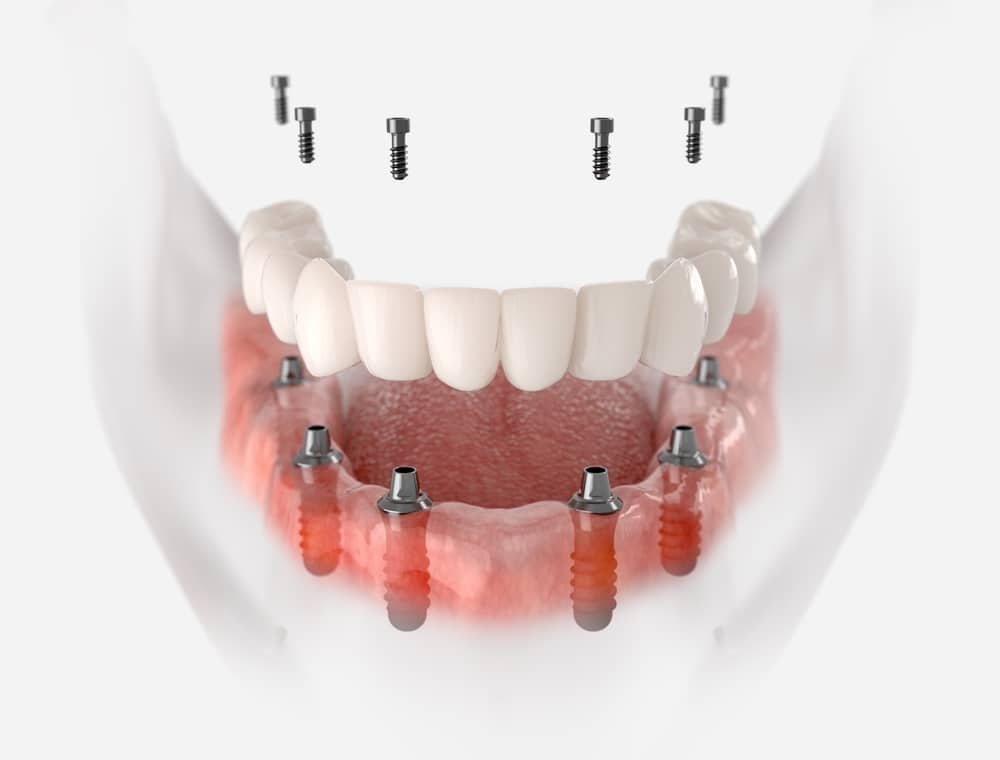 3D illustration of full-arch dental implants