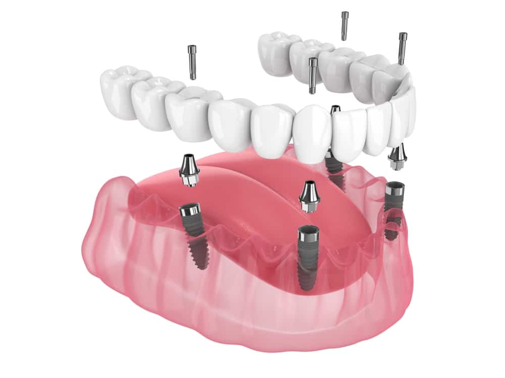 All-on-4 implants shown in a 3D model