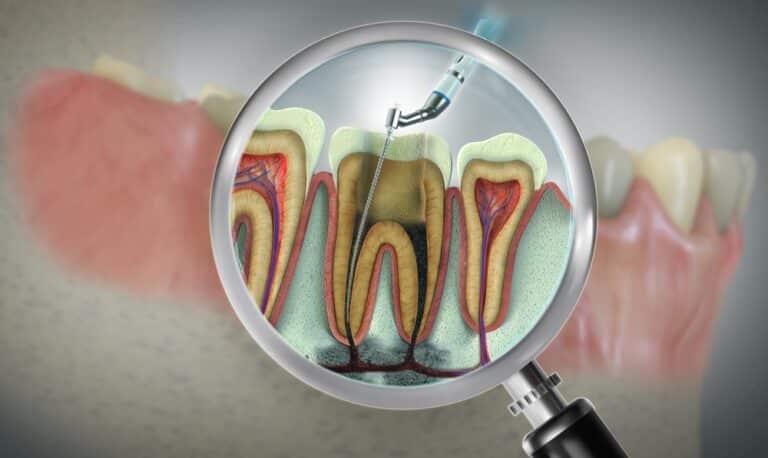 endodontic root canal 3d, Are Root Canals Bad For You? The Truth About Root Canal Safety