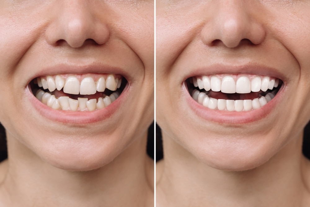 smiling woman’s teeth before and after veneers installation