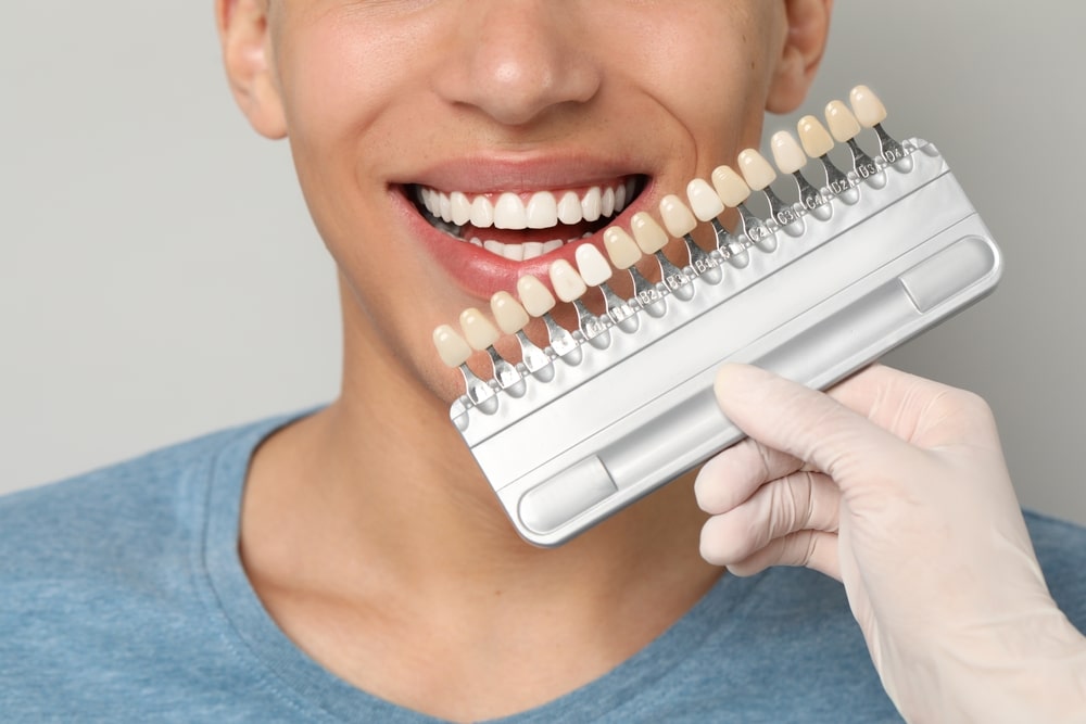 Photo for Are Minimal-Prep Veneers Right for You? The Pros and Cons vs Traditional Veneers