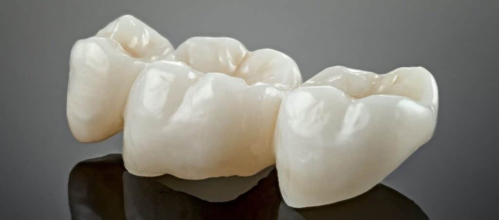 row of ceramic dental crowns