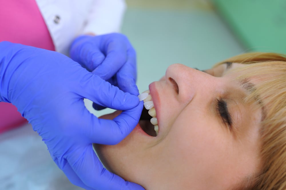 veneer placement, How Much Do Porcelain Veneers Cost?