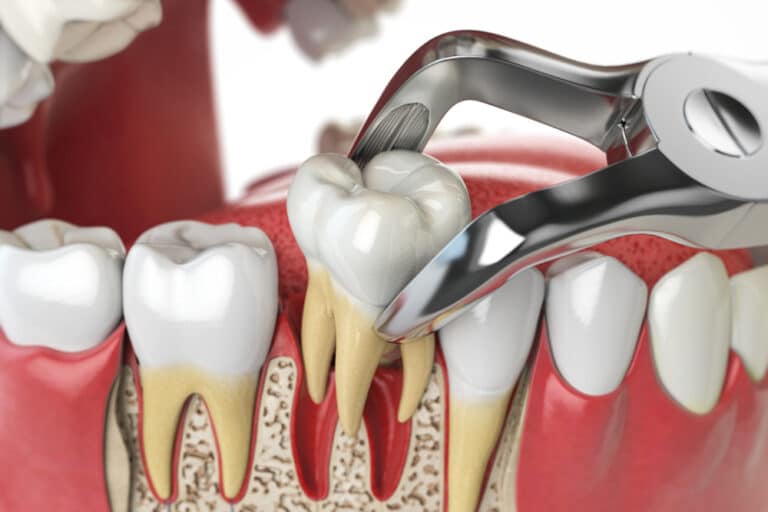 3d tooth extraction, How Much Does A Tooth Extraction Cost?