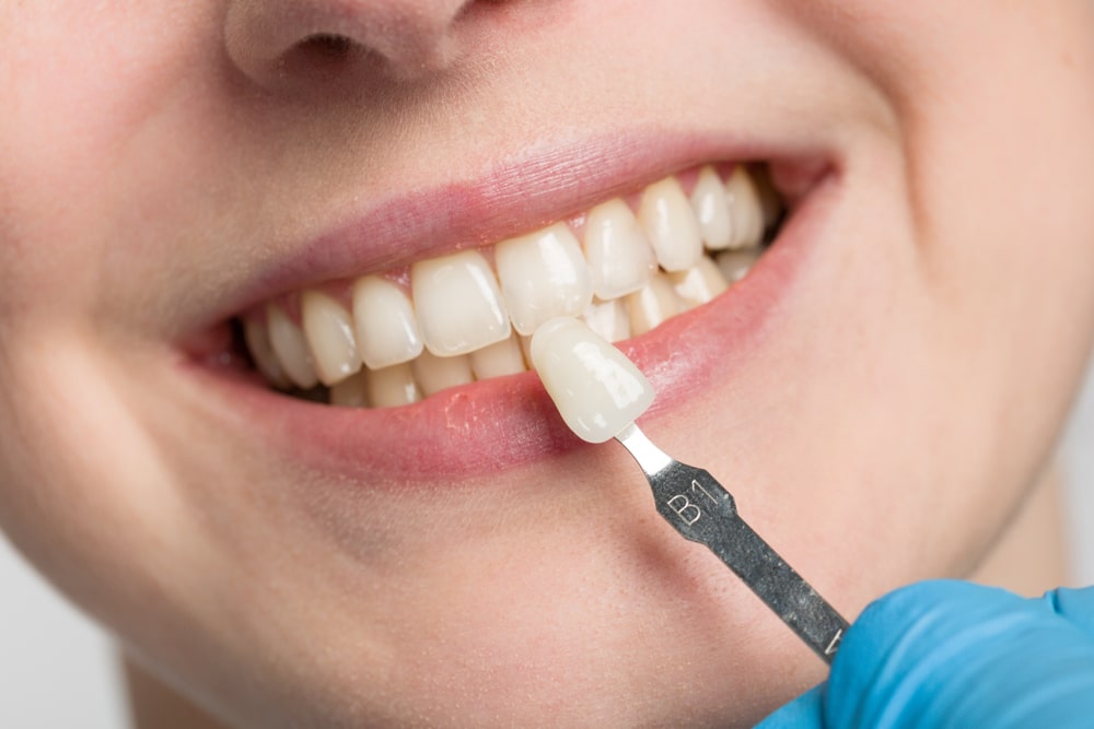 A close-up of matching the right veneer color