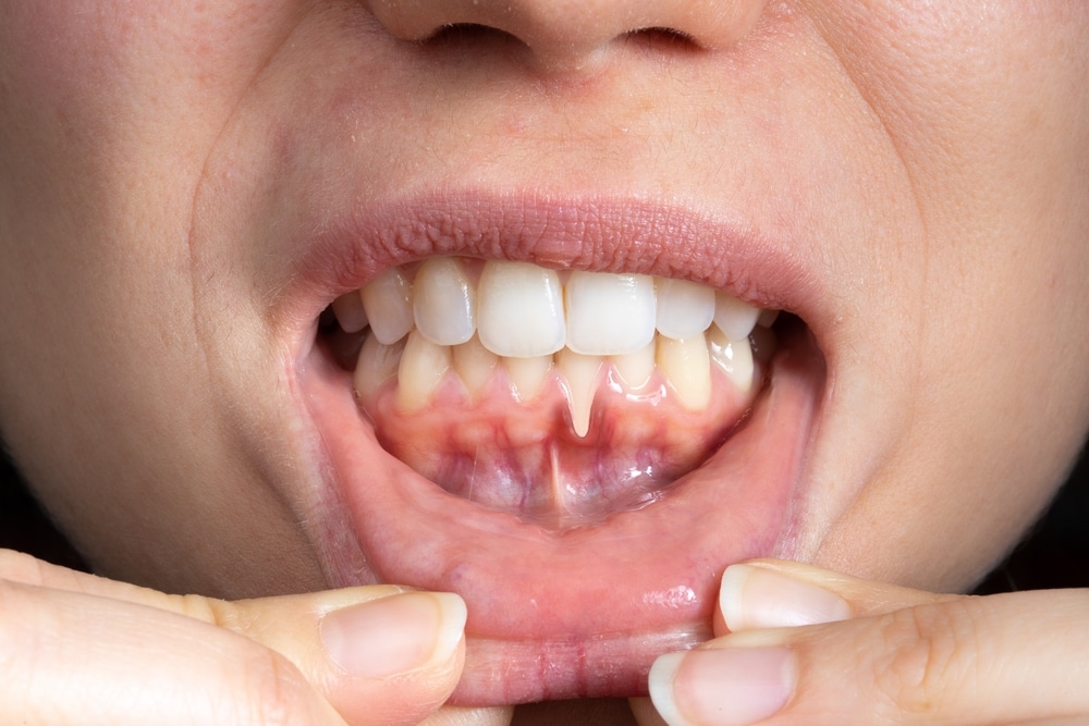Photo for What Causes Receding Gums — and Can They Grow Back?